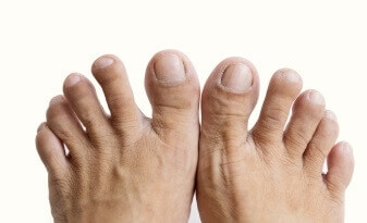 Diabetic Feet